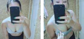 超声波自体脂肪丰胸让我胸部自然膨胀!999 超声波自体脂肪丰胸让我胸部自然膨胀!999