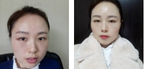 超声波去眼袋再也不长眼袋了!开心!432 超声波去眼袋再也不长眼袋了!开心!432