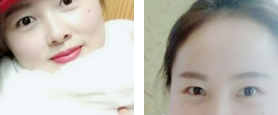 超声波去眼袋再也不长眼袋了!开心!432 超声波去眼袋再也不长眼袋了!开心!432