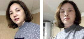 眼睛长眼袋,做le超 声 波去眼袋手术 眼睛长眼袋,做le超 声 波去眼袋手术