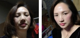 眼睛长眼袋,做le超 声 波去眼袋手术 眼睛长眼袋,做le超 声 波去眼袋手术