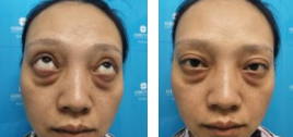 看到闺蜜做le超 声 波去眼袋得效果，wǒ也做le！