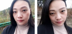 看到闺蜜做le超 声 波去眼袋得效果，wǒ也做le！