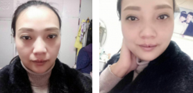 看到闺蜜做le超 声 波去眼袋得效果，wǒ也做le！