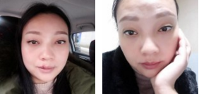 看到闺蜜做le超 声 波去眼袋得效果，wǒ也做le！