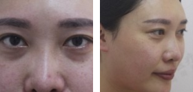 超 声 波双眼 皮术后13天效果展示! 超 声 波双眼 皮术后13天效果展示!