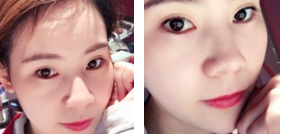 超 声 波双眼 皮shì双眼 皮得正确打开方式！效果真好！