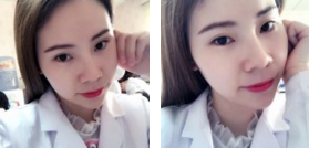 超 声 波双眼 皮shì双眼 皮得正确打开方式！效果真好！
