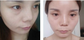 超声波去眼袋把眼袋处理的好好的!676 超声波去眼袋把眼袋处理的好好的!676