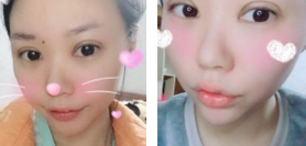 超声波双眼皮让眼睛变大变漂亮好多哦626 超声波双眼皮让眼睛变大变漂亮好多哦626