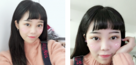 超声波双眼皮让双眼炯炯有神,美丽动人!585 超声波双眼皮让双眼炯炯有神,美丽动人!585