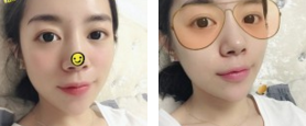 眼袋问题出现后我第一时间做了超声波去眼袋461 眼袋问题出现后我第一时间做了超声波去眼袋461
