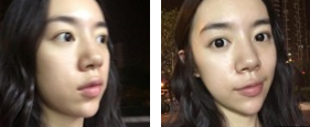 眼袋问题出现后我第一时间做了超声波去眼袋461 眼袋问题出现后我第一时间做了超声波去眼袋461