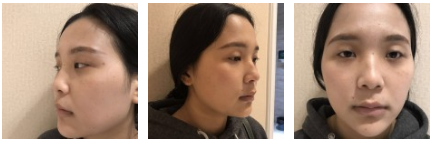 超 声 波双眼 皮术后恢复记录 超 声 波双眼 皮术后恢复记录