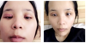 超 声 波双眼 皮术后恢复记录 超 声 波双眼 皮术后恢复记录