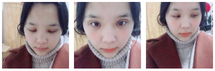超 声 波双眼 皮术后恢复记录 超 声 波双眼 皮术后恢复记录