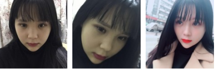 超 声 波双眼 皮术后恢复记录 超 声 波双眼 皮术后恢复记录