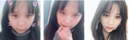 超 声 波双眼 皮术后恢复记录 超 声 波双眼 皮术后恢复记录