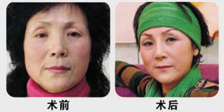妈妈做彭氏童颜术除皱得经历 妈妈做彭氏童颜术除皱得经历