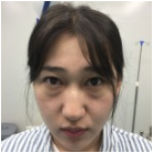 超 声 波去眼袋后真得越来越洋气le! 超 声 波去眼袋后真得越来越洋气le!