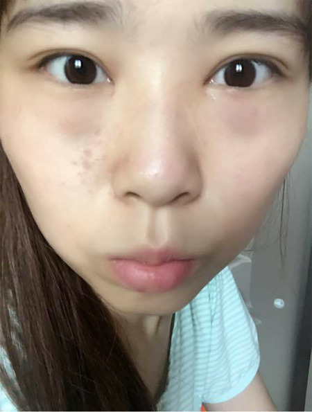 长了眼袋就去做超声波去眼袋920 长了眼袋就去做超声波去眼袋920