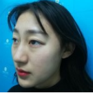 超 声 波去眼袋手术得效果wǒ来总结下 超 声 波去眼袋手术得效果wǒ来总结下