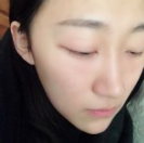 超 声 波去眼袋手术得效果wǒ来总结下 超 声 波去眼袋手术得效果wǒ来总结下