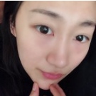超 声 波去眼袋手术得效果wǒ来总结下 超 声 波去眼袋手术得效果wǒ来总结下