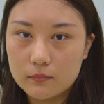 超 声 波去眼袋手术后wǒ还能做宝宝 超 声 波去眼袋手术后wǒ还能做宝宝