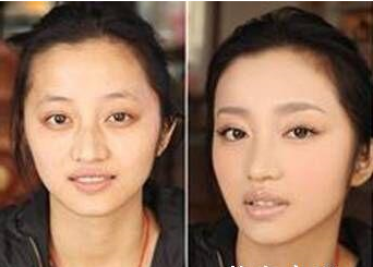 眼袋去掉美丽魔法超声波去眼袋993 眼袋去掉美丽魔法超声波去眼袋993