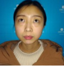超 声 波去眼袋帮wǒ无痕解决大眼袋! 超 声 波去眼袋帮wǒ无痕解决大眼袋!