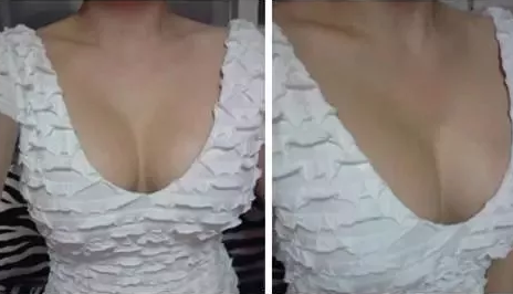 改善哺乳之后胸部下垂缩水的问题就到超雅做超声波自体脂肪丰胸572
