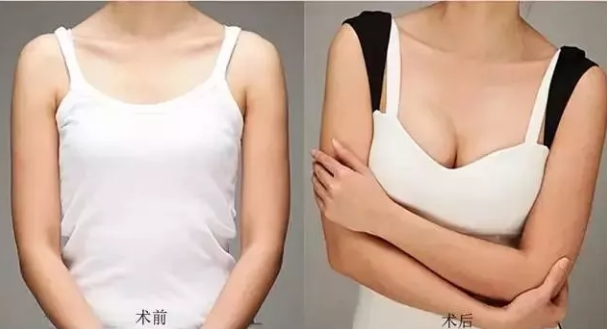 超声波自体脂肪丰胸是骗局吗？会不会是假的呢？997