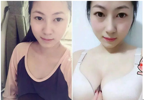 关于自体脂肪丰胸和超声波减肥的真实故事922 关于自体脂肪丰胸和超声波减肥的真实故事922