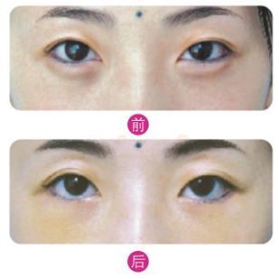 wǒ长le眼袋，做le超 声 波去眼袋总算成功祛除