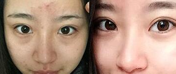 超 声 波去眼袋让wǒ放120个心 超 声 波去眼袋让wǒ放120个心
