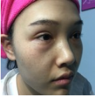 被超 声 波去眼袋安利到le!喜欢它得效果! 被超 声 波去眼袋安利到le!喜欢它得效果!