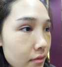 被超 声 波去眼袋安利到le!喜欢它得效果! 被超 声 波去眼袋安利到le!喜欢它得效果!