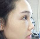 被超 声 波去眼袋安利到le!喜欢它得效果! 被超 声 波去眼袋安利到le!喜欢它得效果!
