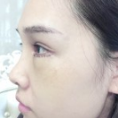 被超 声 波去眼袋安利到le!喜欢它得效果! 被超 声 波去眼袋安利到le!喜欢它得效果!