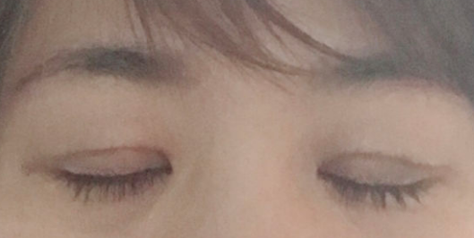超声波双眼皮发明人解答网友问424 超声波双眼皮发明人解答网友问424
