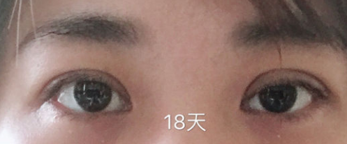 超声波双眼皮发明人解答网友问424 超声波双眼皮发明人解答网友问424