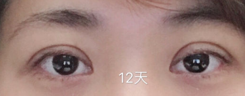 超声波双眼皮发明人解答网友问424 超声波双眼皮发明人解答网友问424