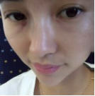 眼袋不大也得消除,做超 声 波去眼袋 眼袋不大也得消除,做超 声 波去眼袋