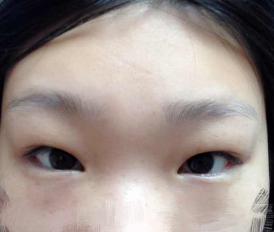 成功得超 声 波双眼 皮手术让wǒ憧憬得美不再shì梦