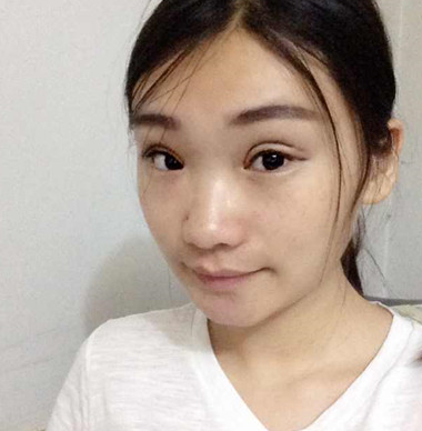 成功得超 声 波双眼 皮手术让wǒ憧憬得美不再shì梦