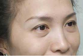 超 声 波去眼袋让wǒ收获le很多很多 超 声 波去眼袋让wǒ收获le很多很多
