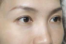 超 声 波去眼袋让wǒ收获le很多很多 超 声 波去眼袋让wǒ收获le很多很多