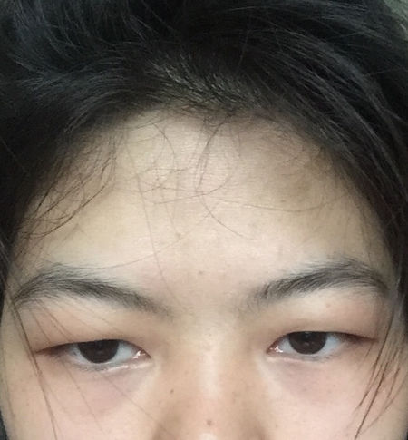 极致明眸术——超 声 波双眼 皮手术 极致明眸术——超 声 波双眼 皮手术