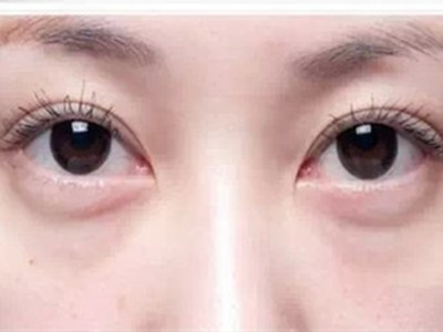 看完就知道超 声 波去眼袋为什么不会复发le！